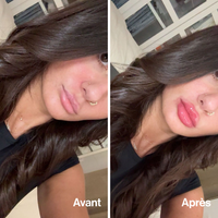 Extreme Lip Volume
