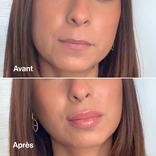 Extreme Lip Volume
