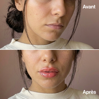 Extreme Lip Volume